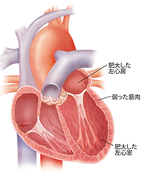 肥大した心臓の断面図。心臓壁が薄くなっています。