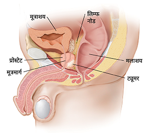 प्रोस्टेट में ट्यूमर दर्शाने वाला पुरुष श्रोणि अंगों का साइड व्यू।